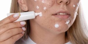 Soins visage acné